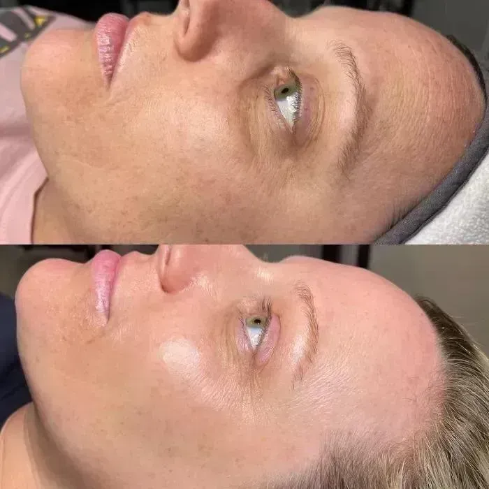 Before and after Microneedling, smoother skin texture
