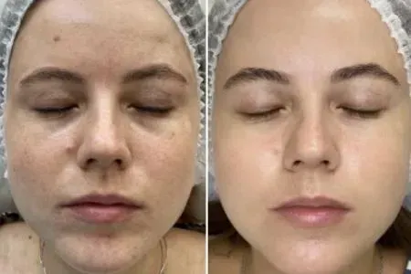 Before and after Microneedling, more even skin