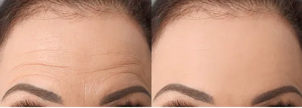 Before and after Microneedling, softer fine lines